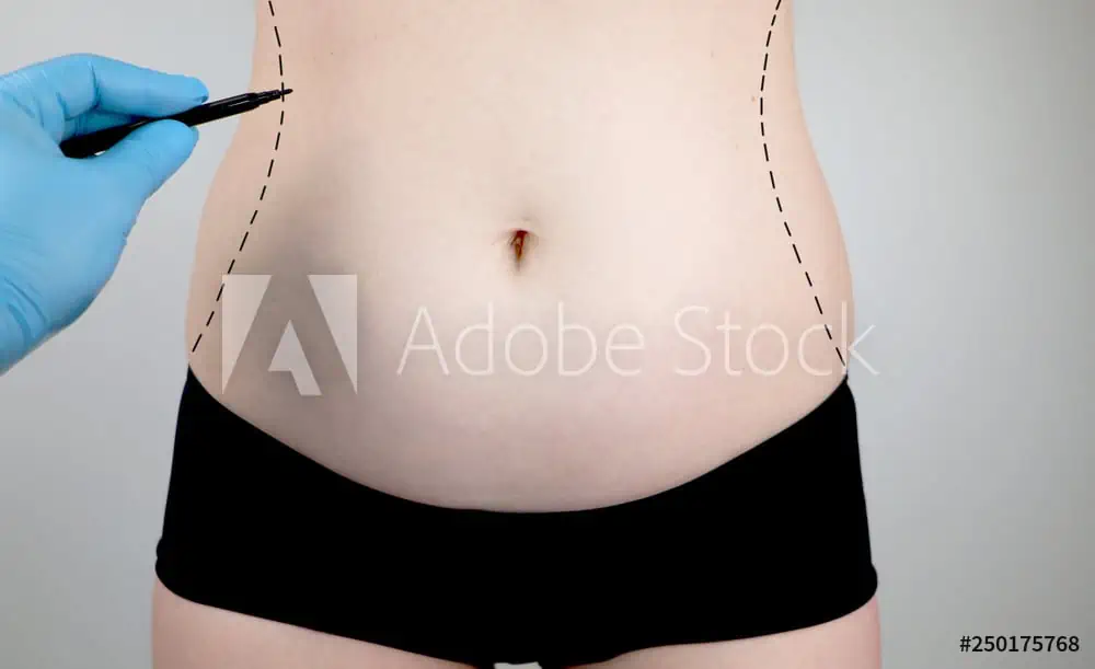 A person in black underwear is shown from the waist to mid-thigh. A plastic surgeon's gloved hand holds a marker, drawing dashed lines on the sides of the abdomen, indicating possible liposuction or cosmetic surgery areas.