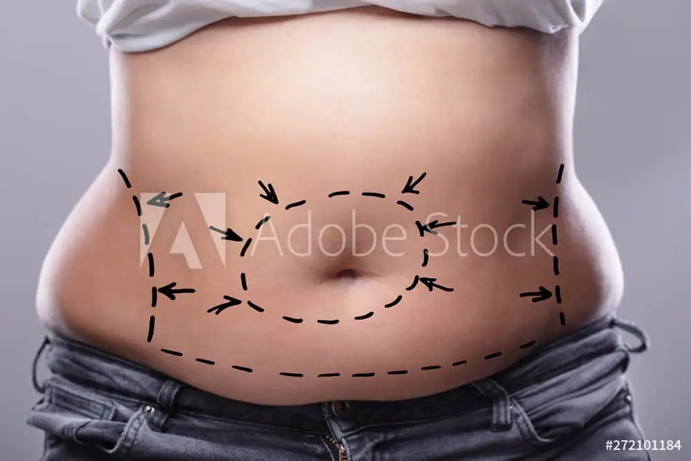 A close-up of a person's midsection with black surgical marking lines and arrows drawn on the skin, indicating areas for a plastic surgeon to perform a cosmetic procedure, such as liposuction or a tummy tuck. The person is wearing jeans.
