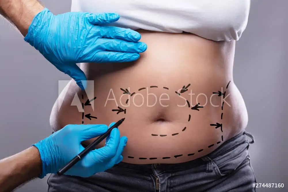 A person’s midsection with black surgical markings, while a plastic surgeon in blue gloves draws on the abdomen, suggests preparation for cosmetic surgery or a medical procedure in Fairfield County.
