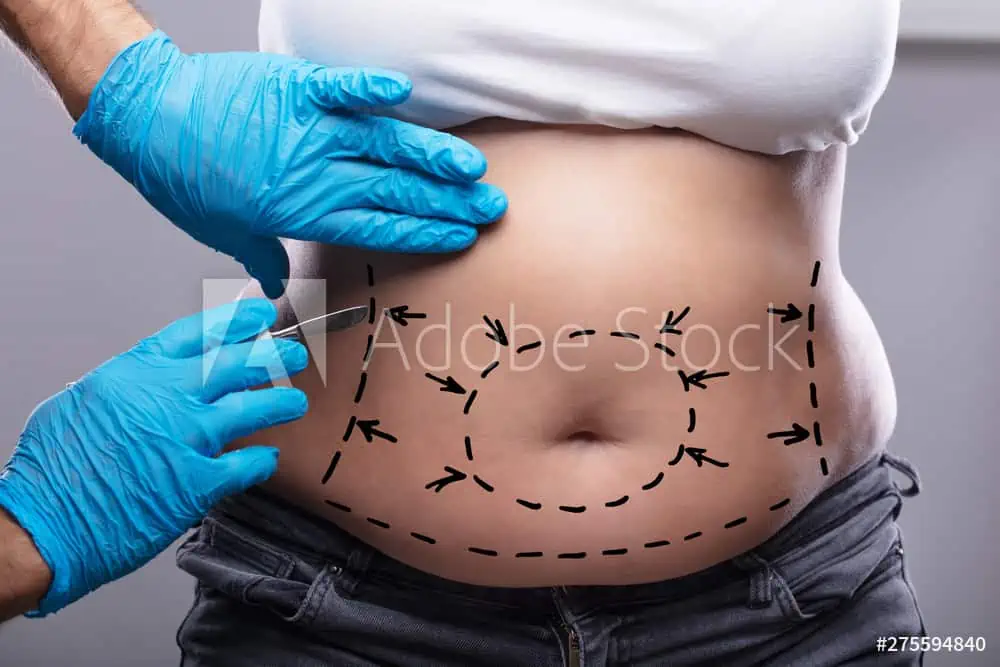 A person’s abdomen marked with dashed and solid lines for surgery, as a Fairfield County plastic surgeon wearing blue gloves prepares to perform a cosmetic liposuction procedure.