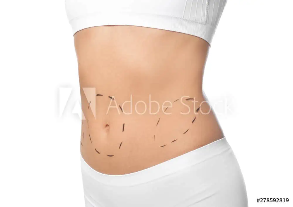Close-up of a woman's midsection with surgical markings on her abdomen, wearing a white sports bra and bottoms, suggesting preparation for liposuction or breast augmentation in Fairfield County.