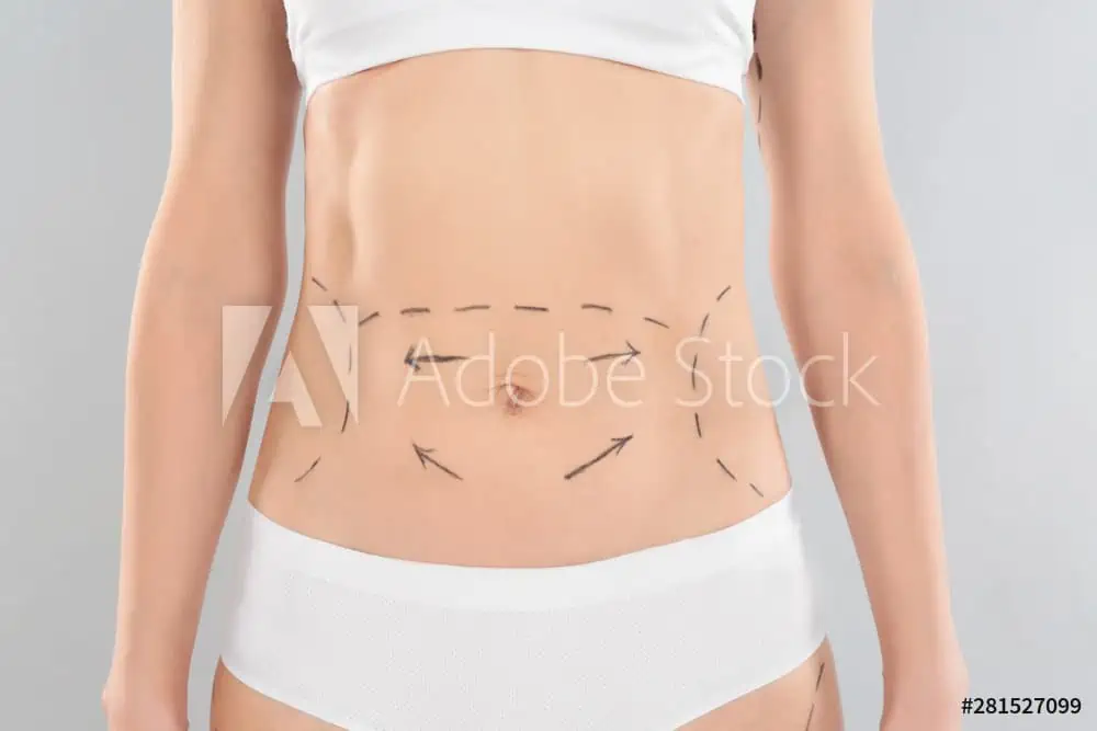 A woman wearing white underwear and a bra stands with her midriff exposed. Black marker lines and arrows on her abdomen indicate areas for possible liposuction or cosmetic surgery in Fairfield County.