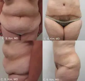 Read more about the article Understanding the Tummy Tuck: A Comprehensive Guide for Fairfield County Patients