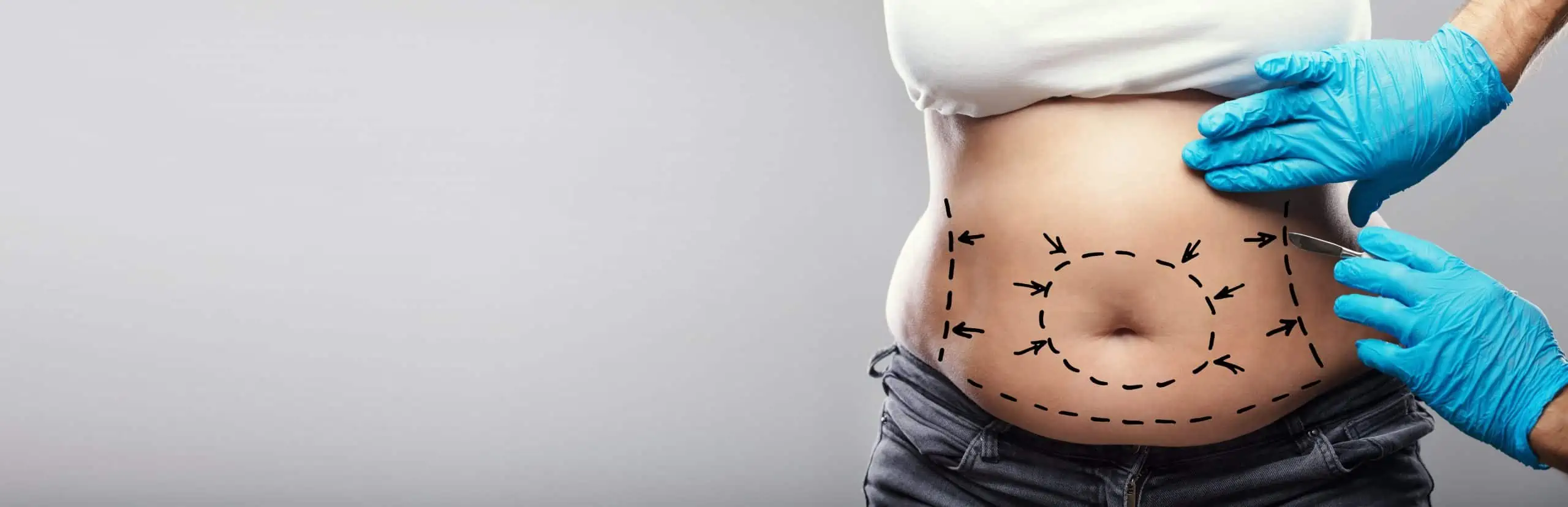 A person’s torso with surgical marker lines on the abdomen, as a plastic surgeon in Fairfield County uses gloved hands to mark and pinch the skin, indicating liposuction or body contouring preparation.