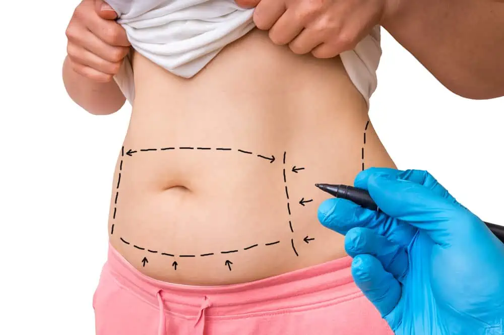A person lifts their shirt to reveal their bare midsection while someone wearing blue gloves draws surgical marker lines and arrows on the skin, indicating possible areas for liposuction or breast augmentation in Fairfield County.