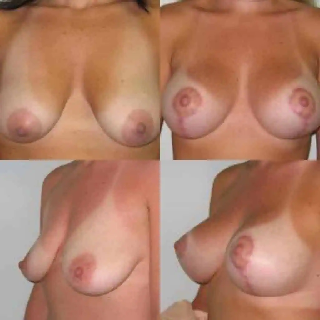 Woman's breast augmentation transformation showing before and after images.